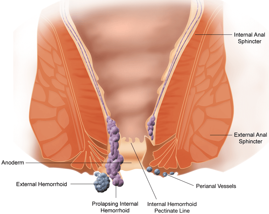 Hemorrhoids develop with pain, itching, and loss of nodules. 