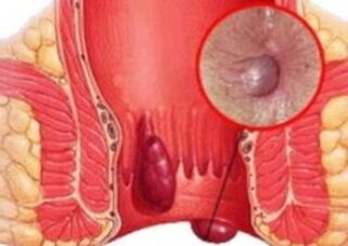 What does hemorrhoids look like 